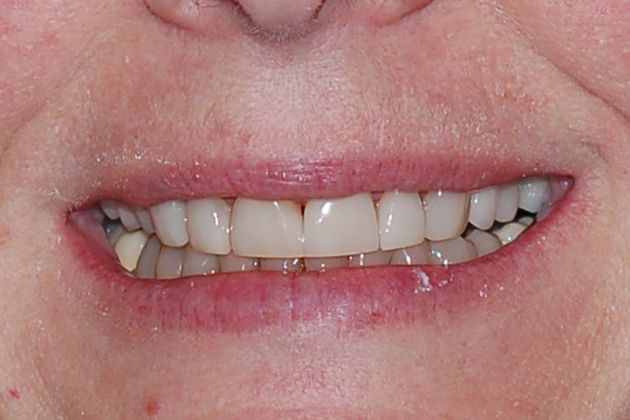 Before porcelain crowns