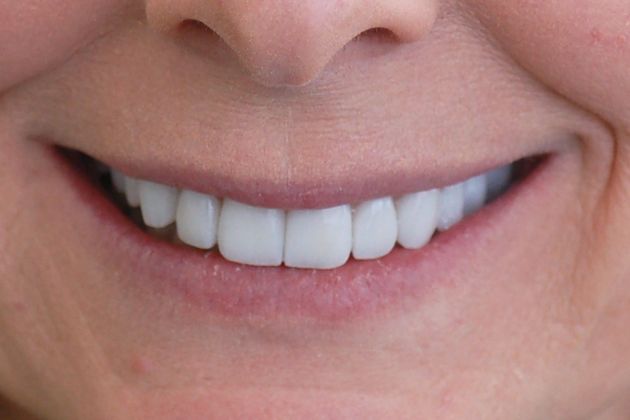 After porcelain crowns